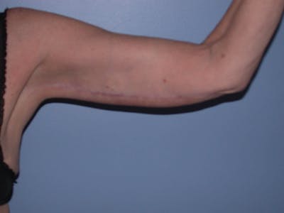 Arm Lift Gallery Before & After Gallery - Patient 4752090 - Image 4