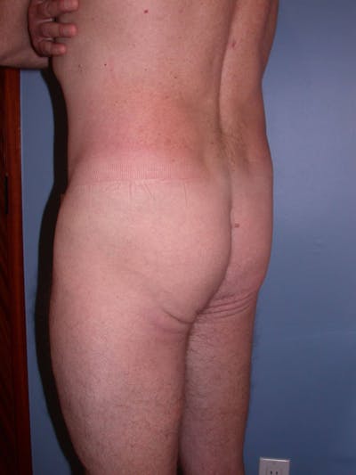 Brazilian Butt Lift Before & After Gallery - Patient 4752158 - Image 1