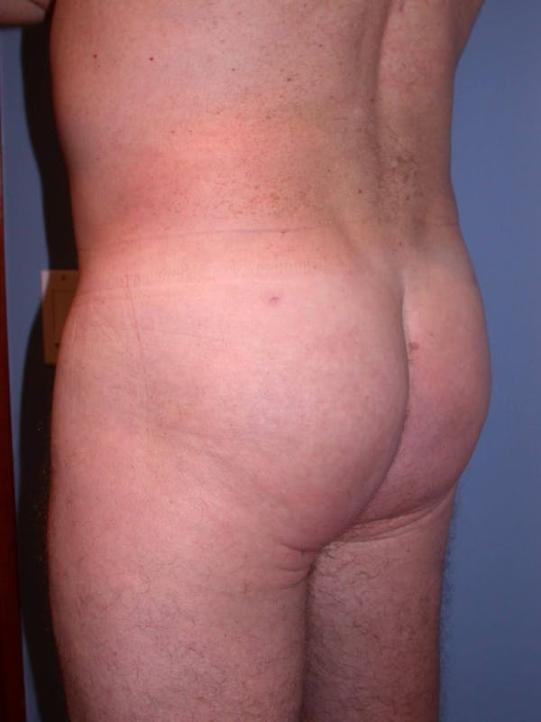 Brazilian Butt Lift Gallery - Patient 4752158 - Image 2