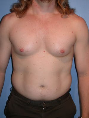 Patient 1 Male Liposuction Before & After
