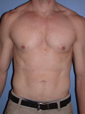 Patient 1 Male Liposuction Before & After