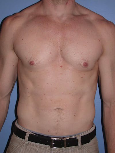 Liposuction Before & After Gallery - Patient 4752168 - Image 2