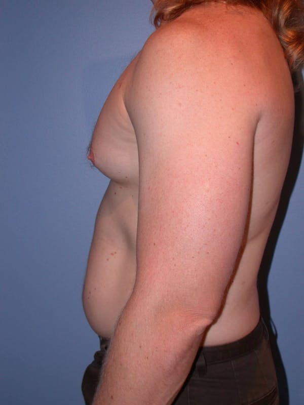 Liposuction Before & After Gallery - Patient 4752168 - Image 3
