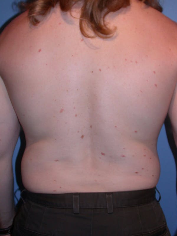 Liposuction Gallery Before & After Gallery - Patient 4752168 - Image 9