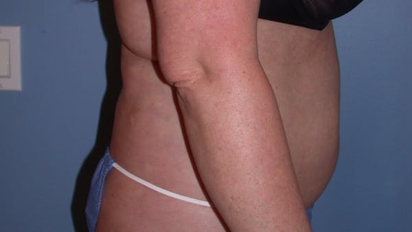 Liposuction Gallery Before & After Gallery - Patient 4752169 - Image 3
