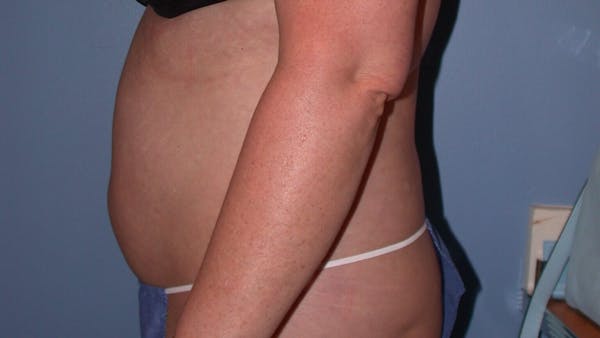 Liposuction Gallery Before & After Gallery - Patient 4752169 - Image 5