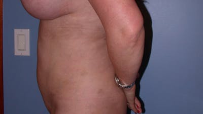 Liposuction Gallery Before & After Gallery - Patient 4752169 - Image 6