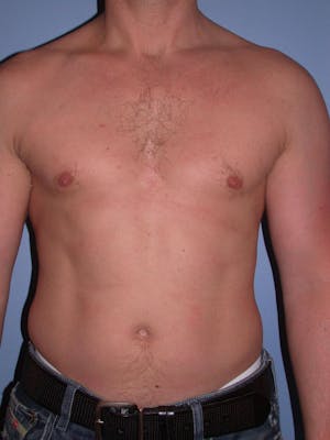Patient 3 Male Liposuction Before & After