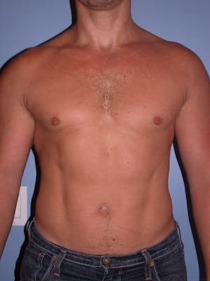 Patient 3 Male Liposuction Before & After