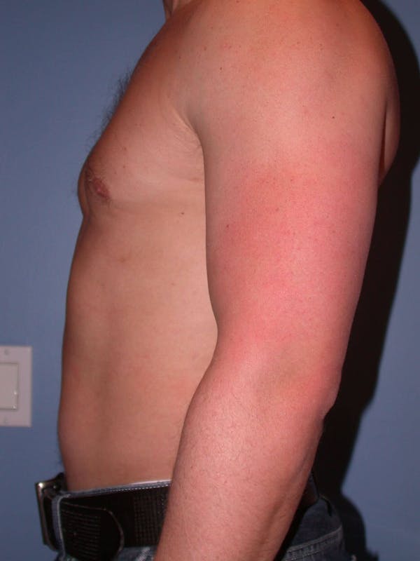 Liposuction Gallery Before & After Gallery - Patient 4752189 - Image 3