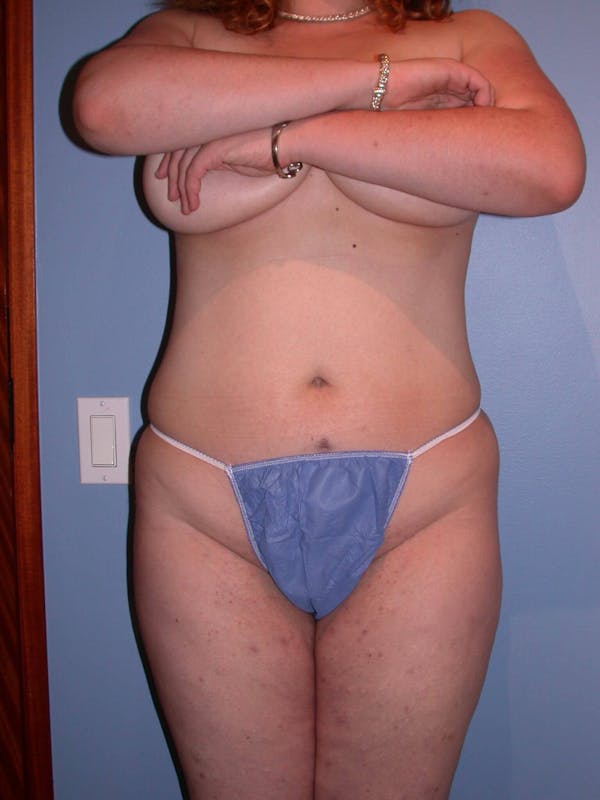 Patient 1 Female Liposuction Before & After