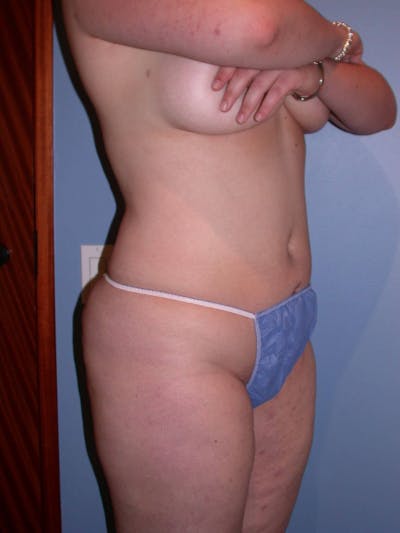 Liposuction Gallery Before & After Gallery - Patient 4752190 - Image 4