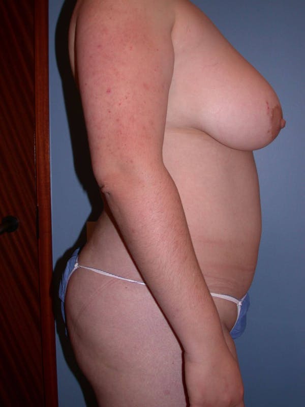 Liposuction Gallery Before & After Gallery - Patient 4752190 - Image 5