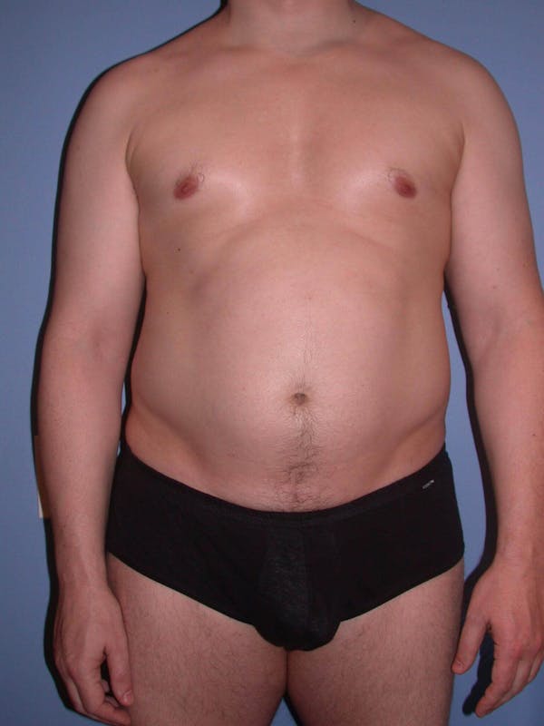 Liposuction Before & After Gallery - Patient 4752194 - Image 1