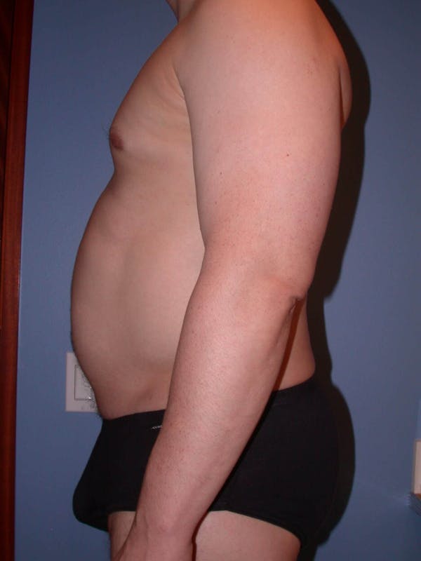 Liposuction Gallery Before & After Gallery - Patient 4752194 - Image 3