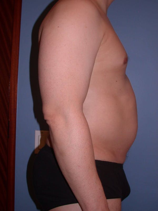 Liposuction Gallery Before & After Gallery - Patient 4752194 - Image 5