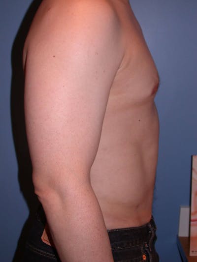 Liposuction Gallery Before & After Gallery - Patient 4752194 - Image 6