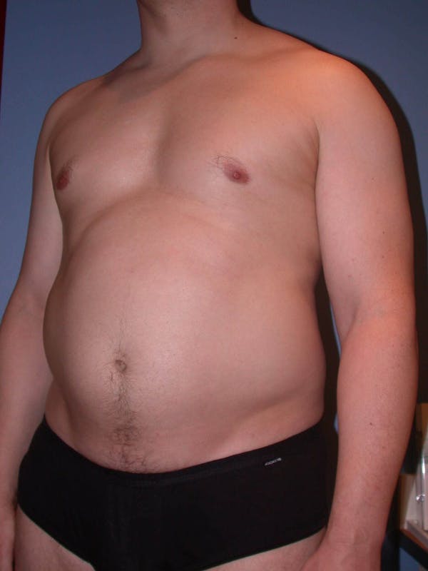 Liposuction Before & After Gallery - Patient 4752194 - Image 7