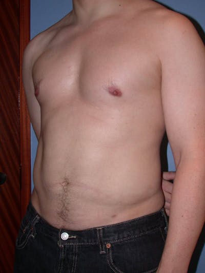 Liposuction Gallery Before & After Gallery - Patient 4752194 - Image 8