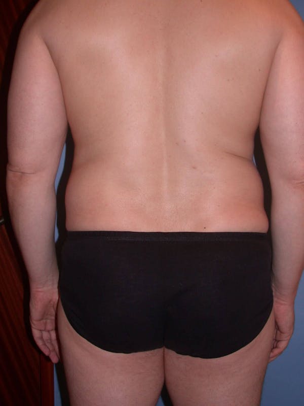 Liposuction Gallery Before & After Gallery - Patient 4752194 - Image 9