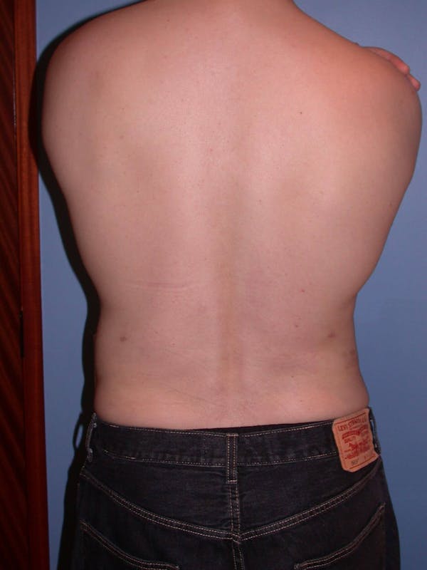 Liposuction Before & After Gallery - Patient 4752194 - Image 10