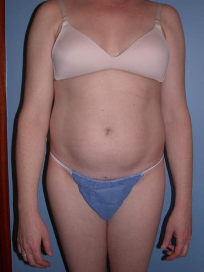 Liposuction Gallery Before & After Gallery - Patient 4752196 - Image 1