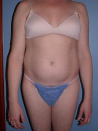 Liposuction Before & After Gallery - Patient 4752196 - Image 1