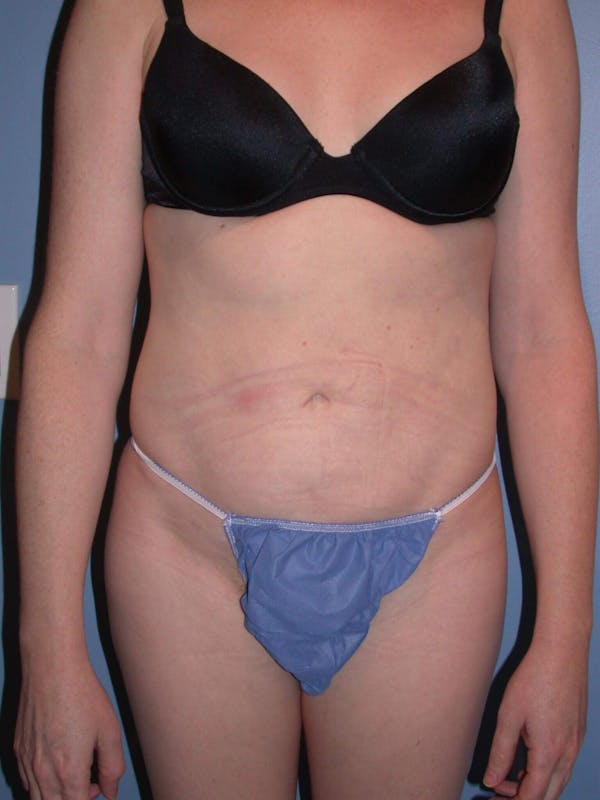 Liposuction Before & After Gallery - Patient 4752196 - Image 2