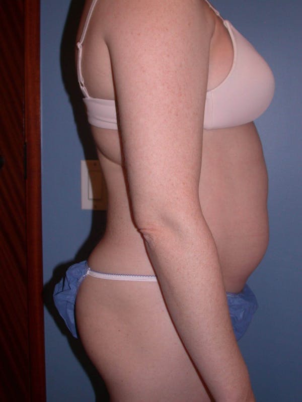 Liposuction Gallery Before & After Gallery - Patient 4752196 - Image 3