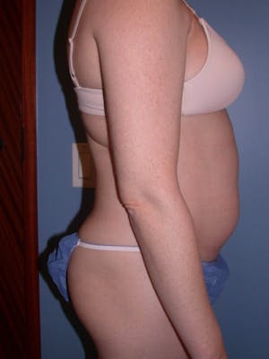 Patient 2 Female Liposuction Before & After