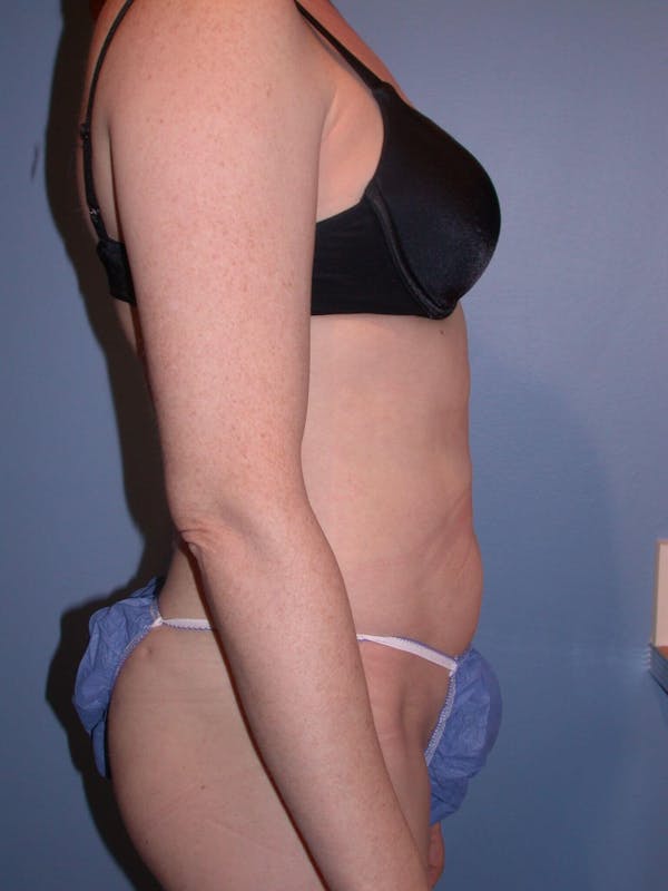 Liposuction Gallery Before & After Gallery - Patient 4752196 - Image 4