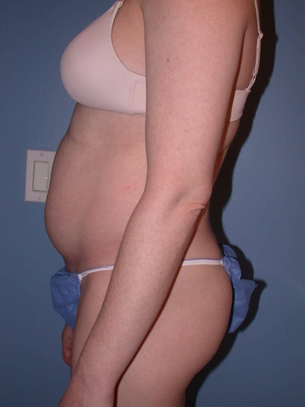 Liposuction Gallery Before & After Gallery - Patient 4752196 - Image 5