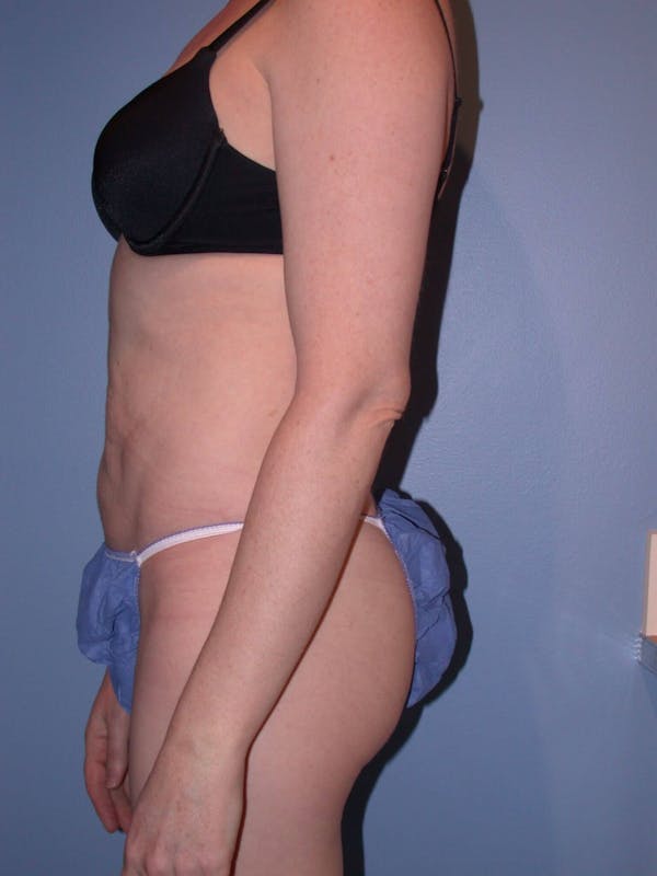 Liposuction Gallery Before & After Gallery - Patient 4752196 - Image 6