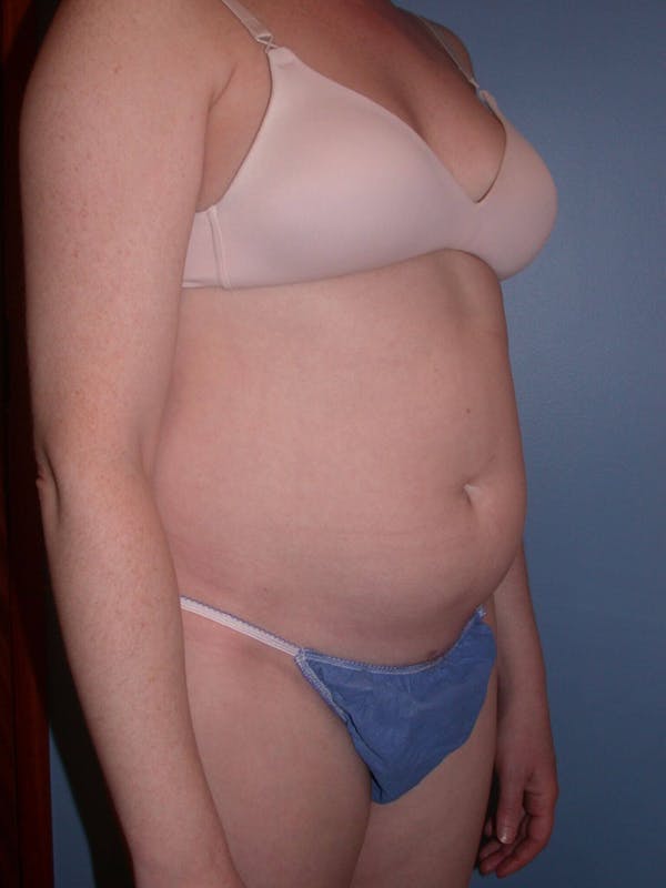 Liposuction Before & After Gallery - Patient 4752196 - Image 7