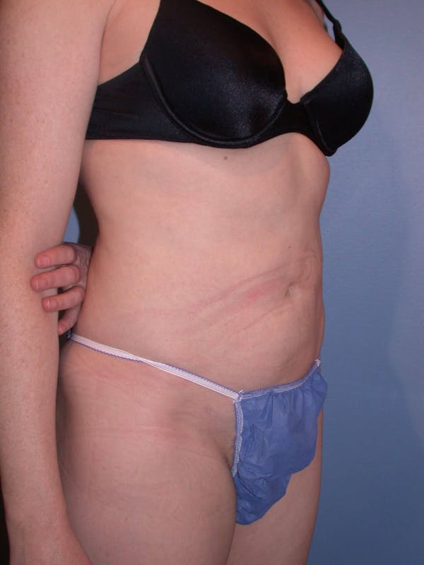 Liposuction Gallery Before & After Gallery - Patient 4752196 - Image 8