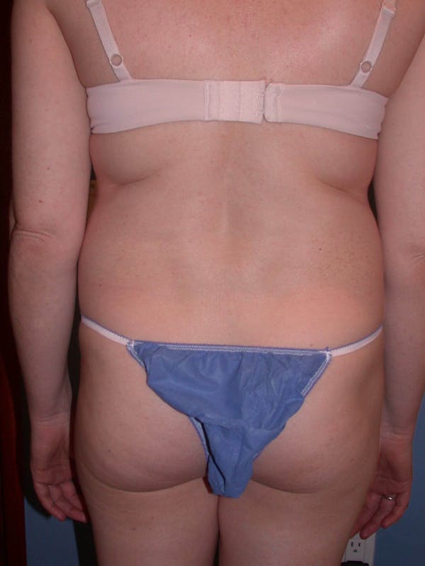 Liposuction Gallery Before & After Gallery - Patient 4752196 - Image 9