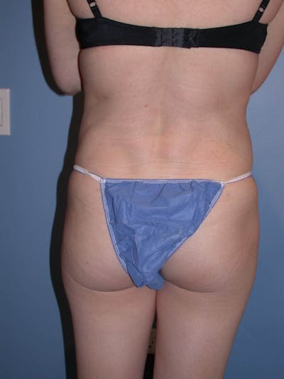 Liposuction Gallery Before & After Gallery - Patient 4752196 - Image 10