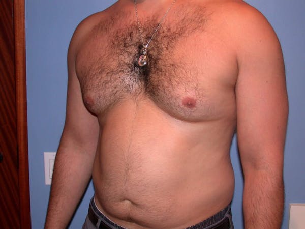 Liposuction Gallery Before & After Gallery - Patient 4752201 - Image 7