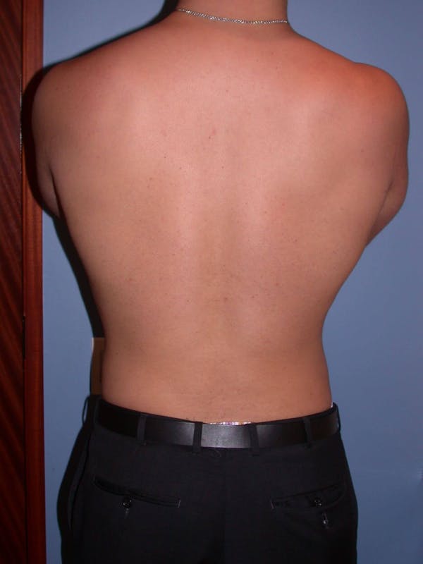 Liposuction Before & After Gallery - Patient 4752201 - Image 10