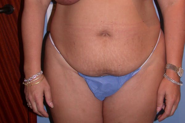 Liposuction Before & After Gallery - Patient 4752203 - Image 1