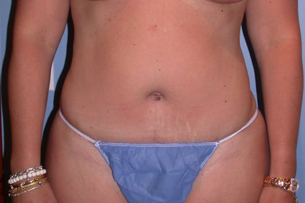 Liposuction Before & After Gallery - Patient 4752203 - Image 2