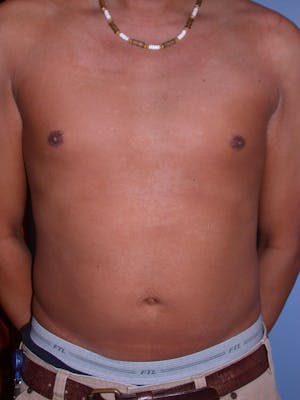 Patient 5 Male Liposuction Before & After