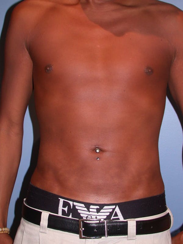 Patient 5 Male Liposuction Before & After