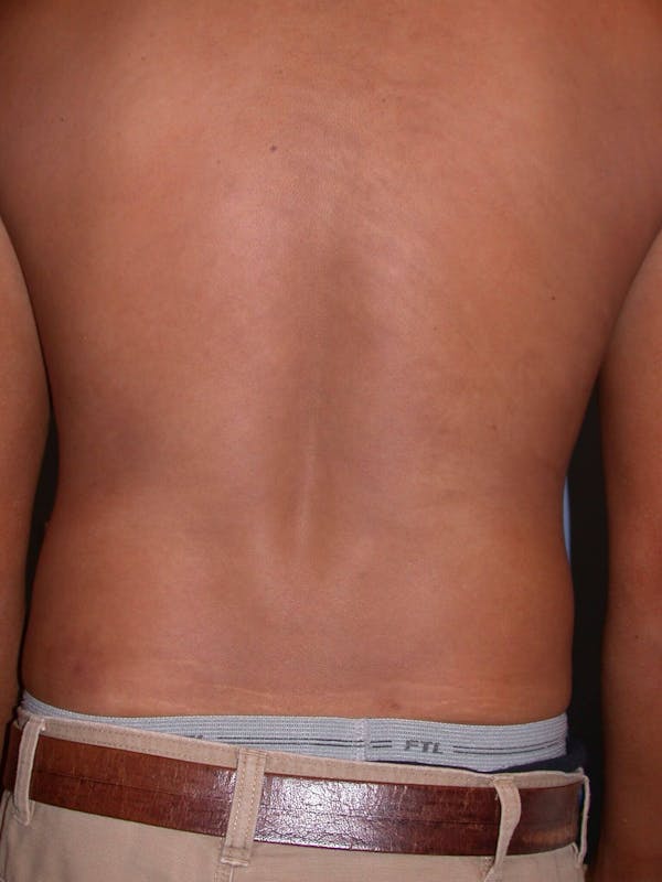 Liposuction Gallery Before & After Gallery - Patient 4752205 - Image 7