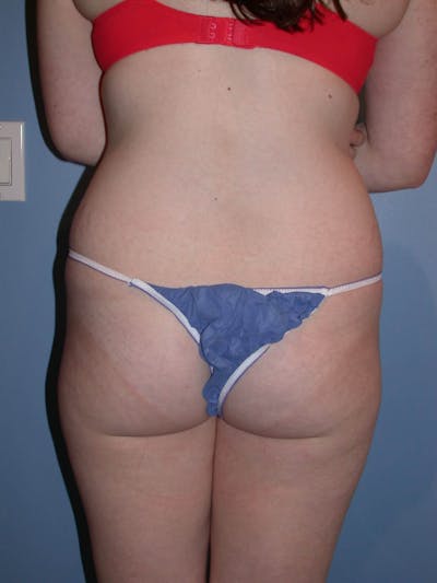 Liposuction Gallery Before & After Gallery - Patient 4752207 - Image 1