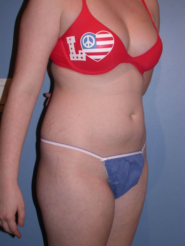 Liposuction Gallery Before & After Gallery - Patient 4752207 - Image 5