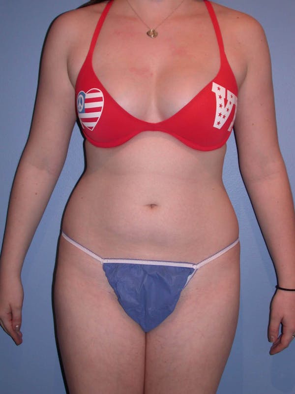 Liposuction Gallery Before & After Gallery - Patient 4752207 - Image 7