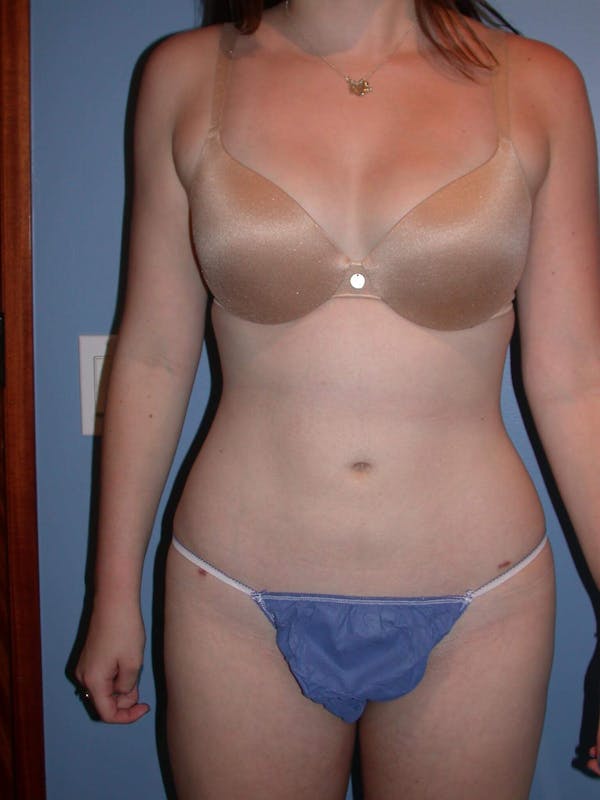 Liposuction Before & After Gallery - Patient 4752207 - Image 8