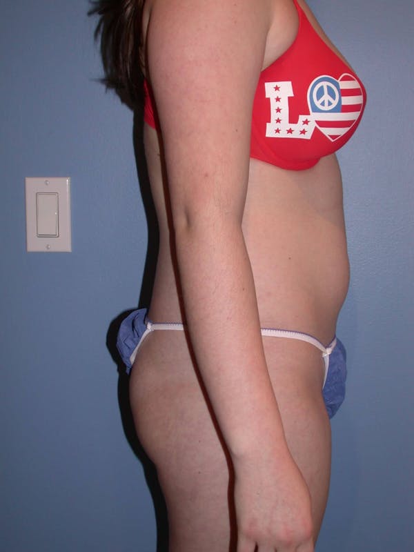 Liposuction Gallery Before & After Gallery - Patient 4752207 - Image 9