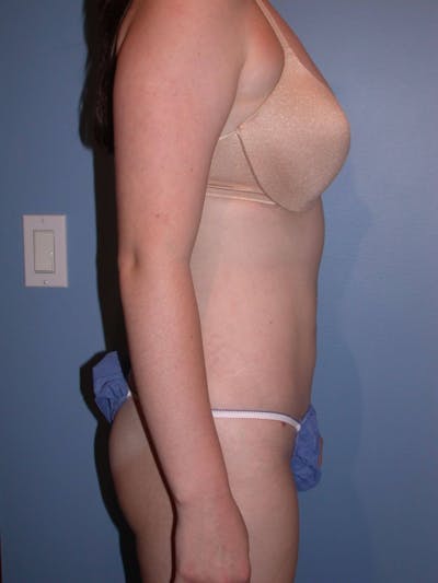 Liposuction Gallery Before & After Gallery - Patient 4752207 - Image 10